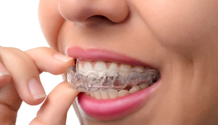 Advantages Of Invisalign